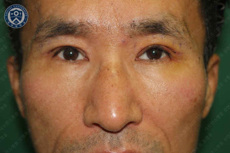 남자눈성형: 무쌍눈매교정 (Blephroptosis correction-levator aponeurosis advancement) 관련 이미지 22