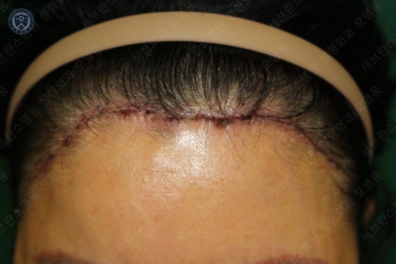71세 여성, 이마거상술과 이마축소술 (71/F, Forehead lift and reduction) 관련 이미지 28