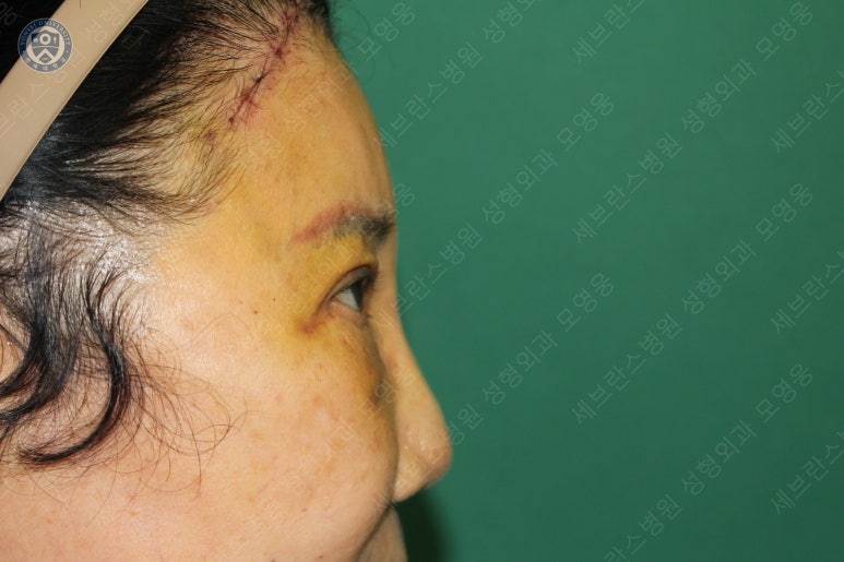 71세 여성, 이마거상술과 이마축소술 (71/F, Forehead lift and reduction) 관련 이미지 27