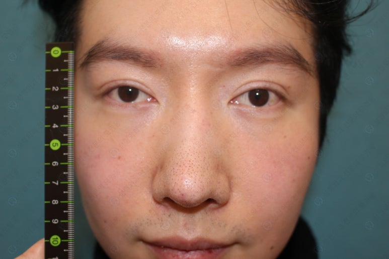 29세 남자, 소시지 쌍꺼풀 두줄따기로 낮추기 (쌍꺼풀 재수술) 관련 이미지 16