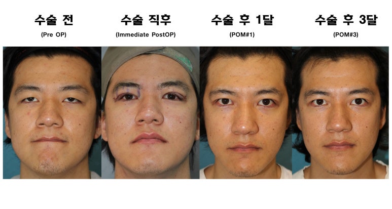 27세 남성 무쌍(속쌍)눈매교정 (27/M Ptosis correction with double lid plasty) 관련 이미지 38