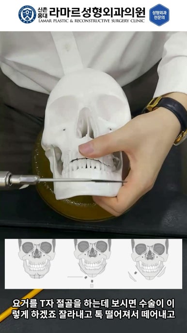 성형수술의 끝판! 성형외과 윤곽수술을 알려드립니다. 저희병원에서 사용하는 수술기구, 그리고 윤곽3종 모의수술....!! 관련 이미지 52
