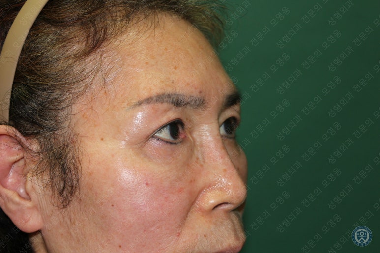 64세 여성 상안검성형술+눈매교정 (64/F Upper blepharoplasty with ptosis correction) 관련 이미지 40