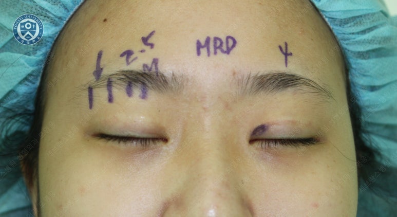 17세 여성, 비절개 눈매교정 및 앞트임 재수술 (17/F NI ptosis correction & Med. epicanthoplasty revision) 증례 관련 이미지 9