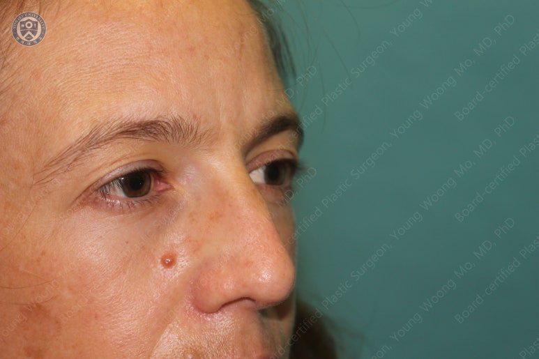 38세 서양 백인 여성, 쌍꺼풀 수술과 눈매교정 및 하안검성형술 (38/F Upper&lower blepharoplasty with levator plication) 관련 이미지 8