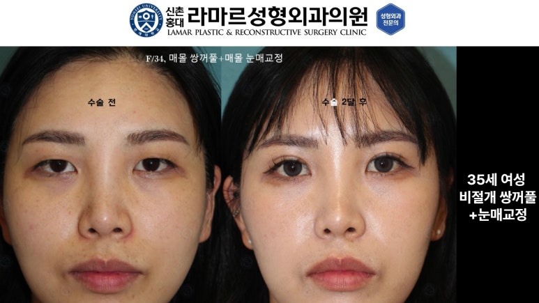 10대~30대 눈 수술 케이스 : 대표원장님 쌍꺼풀 전후 사진 모음 관련 이미지 22
