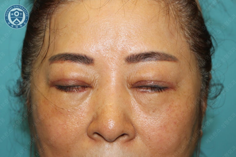 60세 여성, 상안검 및 하안검 성형술 증례 (60/F Upper & lower blepharoplasty) 관련 이미지 16
