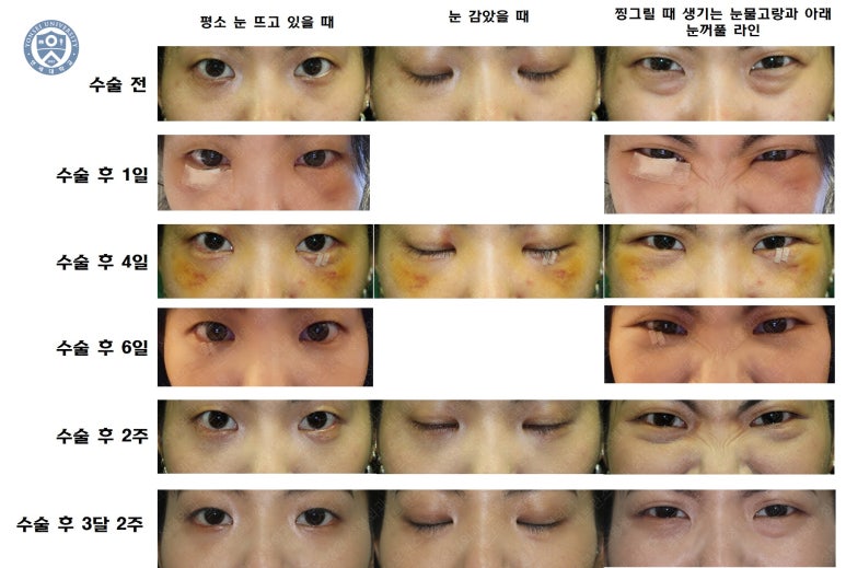 28세 여성, 눈밑지방재배치(눈밑지, 28/F Transconjunctival septal fat redraping-internal fixation technique) 관련 이미지 30