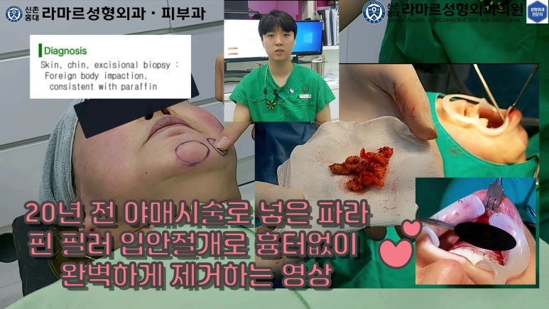 파라핀 필러 입 안 절개로 흉터없이 빼내기! 관련 이미지 5