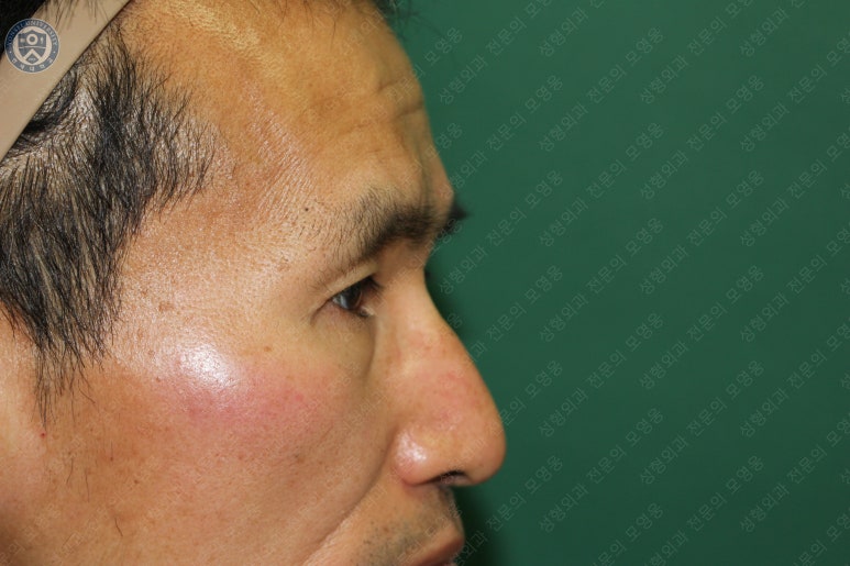 남자눈성형: 무쌍눈매교정 (Blephroptosis correction-levator aponeurosis advancement) 관련 이미지 44