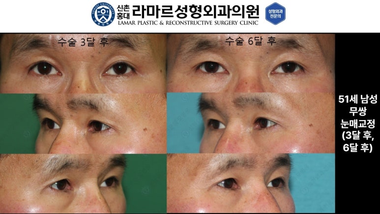 40대~80대 눈 수술 케이스 : 상안검성형술 전후 사진 모음 관련 이미지 7