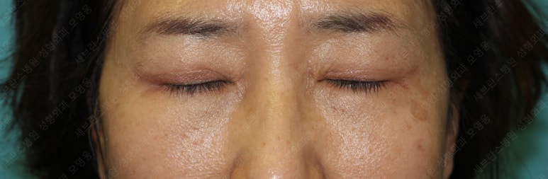 55세 여성, 상안검 및 하안검 성형술 증례 (55/F Upper & lower blepharoplasty) 관련 이미지 21