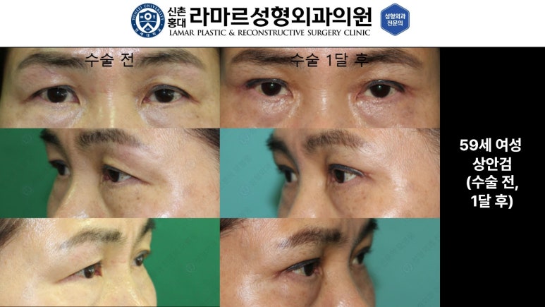 40대~80대 눈 수술 케이스 : 상안검성형술 전후 사진 모음 관련 이미지 18