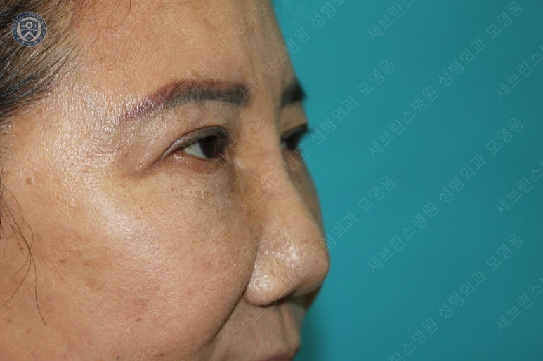 71세 여성, 이마거상술과 이마축소술 (71/F, Forehead lift and reduction) 관련 이미지 46