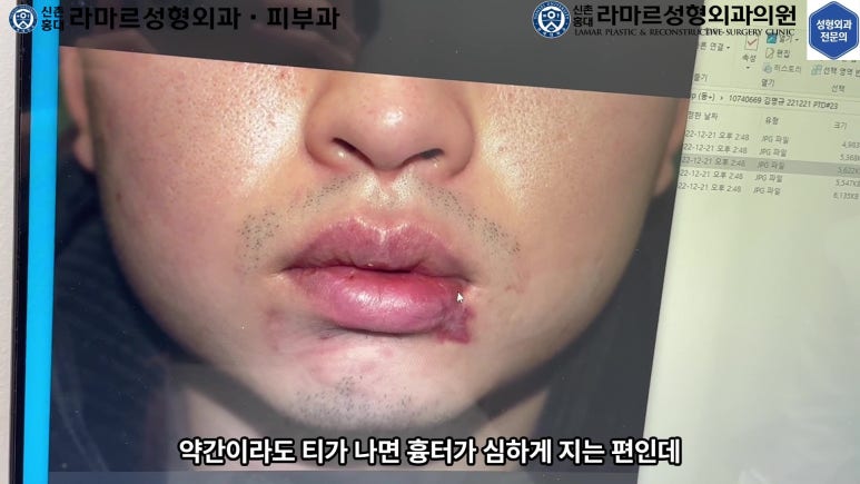 개에 물려 입술 1/3이 뜯긴 19세 남자분 치료 및 흉터 성형수술& 레이저 후기....! 관련 이미지 31