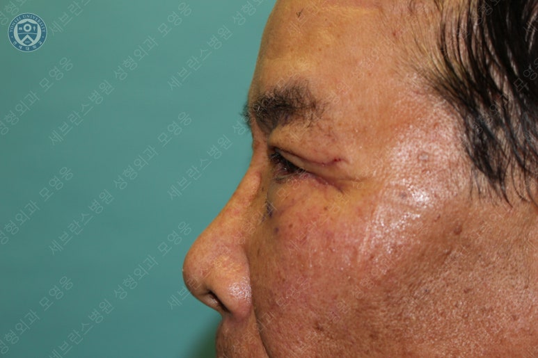 67세 남성, 상&middot;하안검성형술 및 안검하수교정 (67/M, Upper &  lower blepharoplasty with ptosis correction) 관련 이미지 24