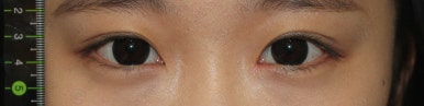 17세 여성, 쌍꺼풀+앞트임(DEO+Medial epicanthoplasty) 관련 이미지 47