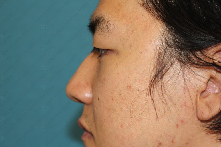 27세 남성 무쌍(속쌍)눈매교정 (27/M Ptosis correction with double lid plasty) 관련 이미지 9