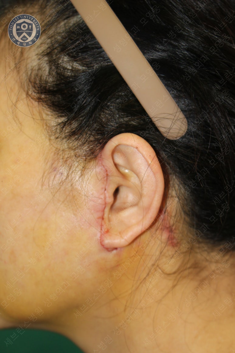 55세 여성, 이중평면 안면거상(55/F, Dual-plane full facelift) 관련 이미지 30