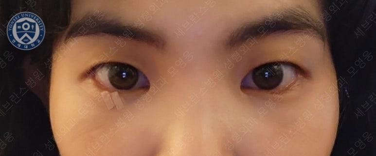 28세 여성, 눈밑지방재배치(눈밑지, 28/F Transconjunctival septal fat redraping-internal fixation technique) 관련 이미지 16
