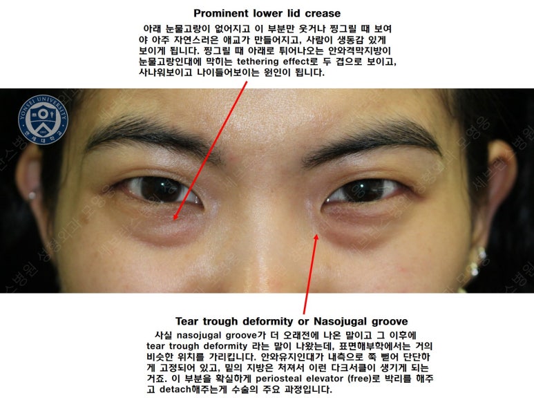 28세 여성, 눈밑지방재배치(눈밑지, 28/F Transconjunctival septal fat redraping-internal fixation technique) 관련 이미지 13