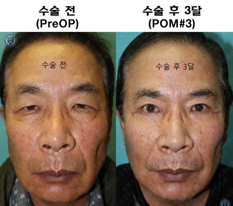 67세 남성, 상&middot;하안검성형술 및 안검하수교정 (67/M, Upper &  lower blepharoplasty with ptosis correction) 관련 이미지 44