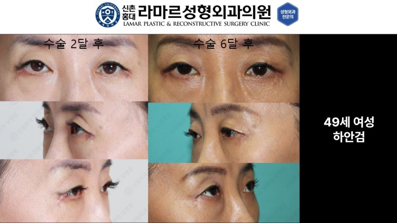 30대~80대 눈 수술 케이스 : 하안검성형술 전후 사진 모음 관련 이미지 39