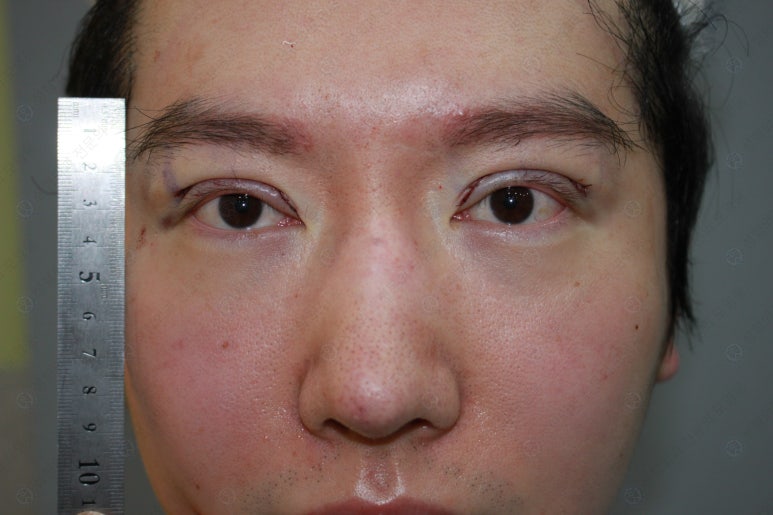 29세 남자, 소시지 쌍꺼풀 두줄따기로 낮추기 (쌍꺼풀 재수술) 관련 이미지 80