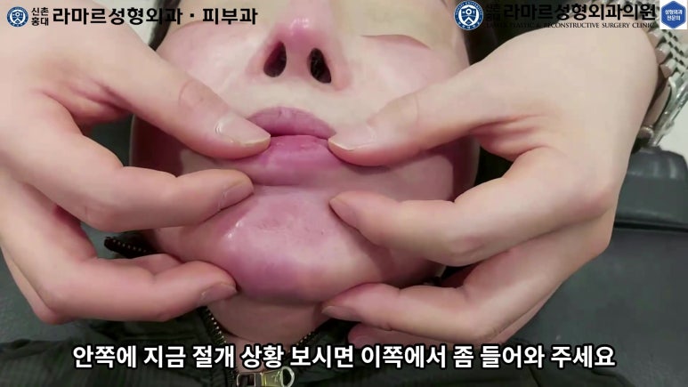 파라핀 필러 입 안 절개로 흉터없이 빼내기! 관련 이미지 107