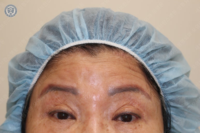 71세 여성, 이마거상술과 이마축소술 (71/F, Forehead lift and reduction) 관련 이미지 11