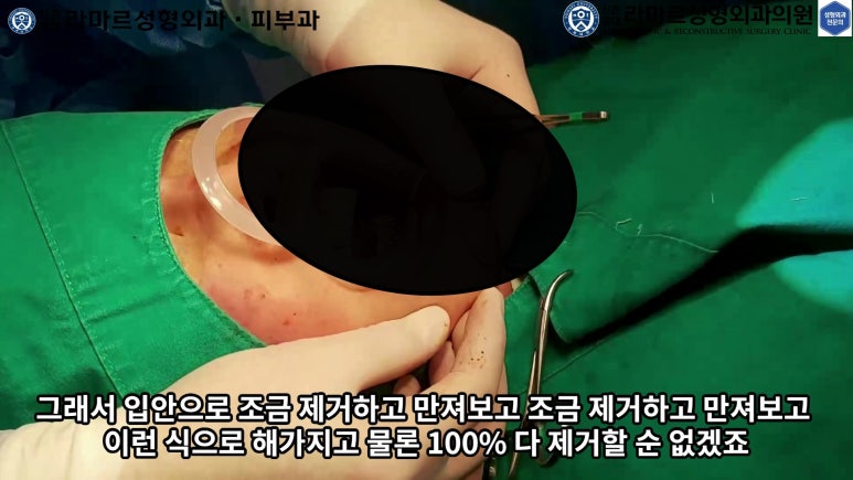 파라핀 필러 입 안 절개로 흉터없이 빼내기! 관련 이미지 78