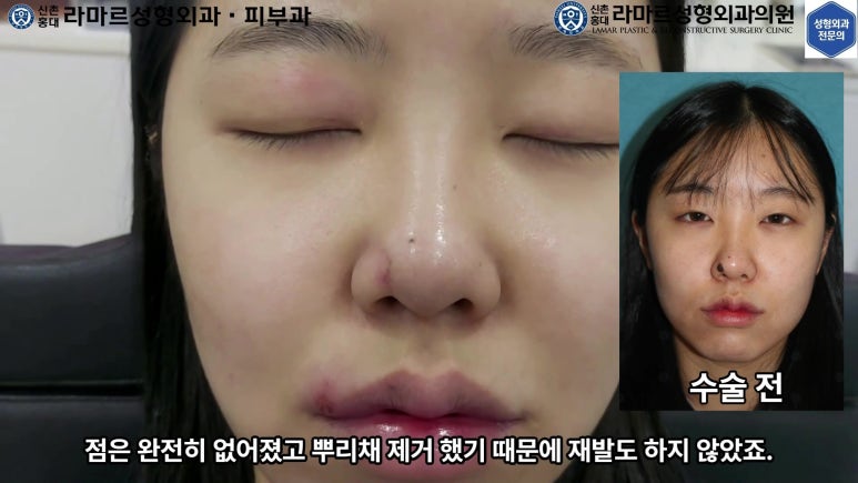 21세 여성 코 지름 1cm 점 제거수술 : 나선피판술(Spiral Flap) 수술전~5달 경과. (+쌍꺼풀수술, 코필러) 관련 이미지 19