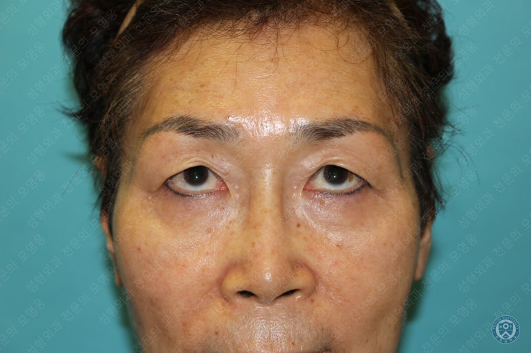 64세 여성 상안검성형술+눈매교정 (64/F Upper blepharoplasty with ptosis correction) 관련 이미지 5