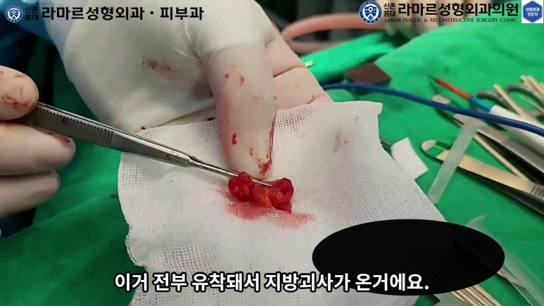 파라핀 필러 입 안 절개로 흉터없이 빼내기! 관련 이미지 52