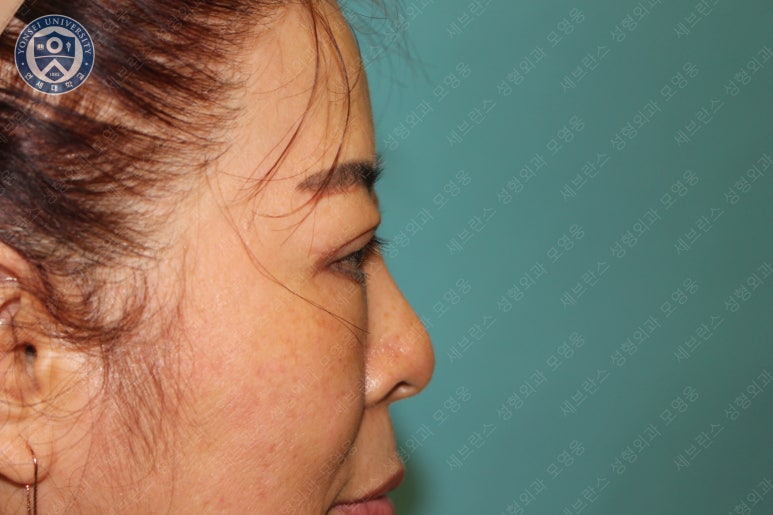 60세 여성, 상안검 및 하안검 성형술 증례 (60/F Upper & lower blepharoplasty) 관련 이미지 21