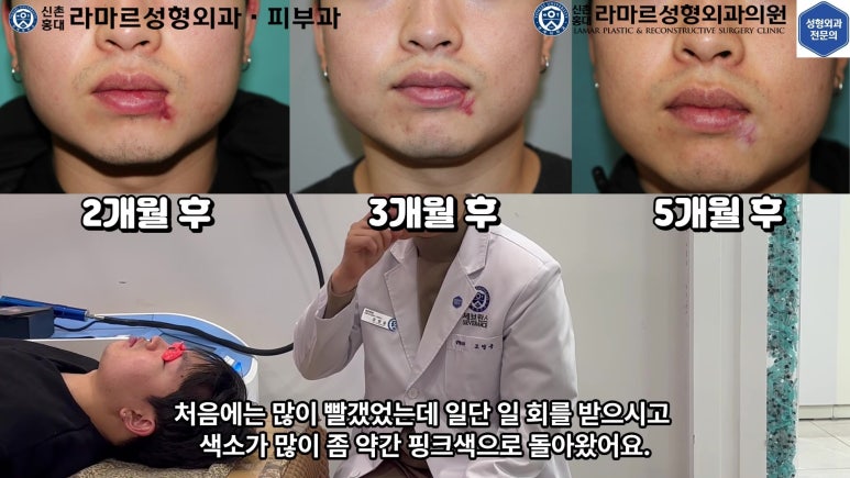 개에 물려 입술 1/3이 뜯긴 19세 남자분 치료 및 흉터 성형수술& 레이저 후기....! 관련 이미지 63