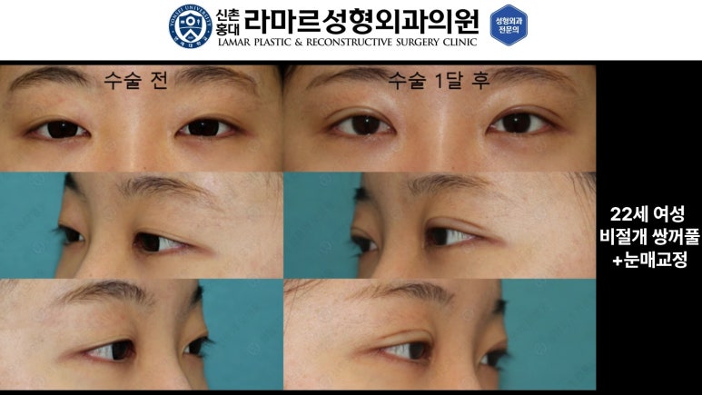 10대~30대 눈 수술 케이스 : 대표원장님 쌍꺼풀 전후 사진 모음 관련 이미지 17