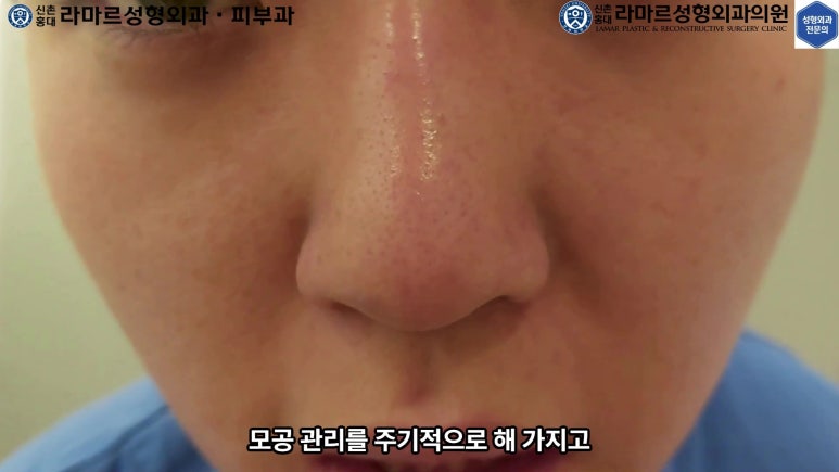 저의 코 모공, 블랙헤드 관리 실제 영상 및 후기~! 관련 이미지 8