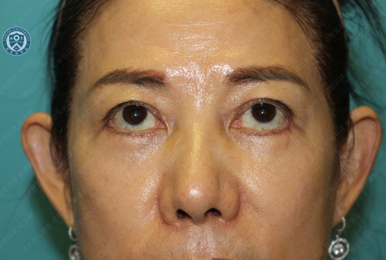 59세 여성, 그레이브스 안병증이 있는 돌출눈 중년 여성 하안검 성형술 (Lower blepharoplasty in Graves 관련 이미지 28