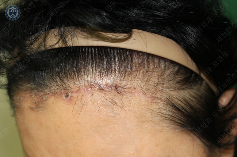 71세 여성, 이마거상술과 이마축소술 (71/F, Forehead lift and reduction) 관련 이미지 39