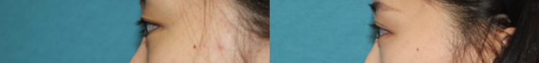 17세 여성, 쌍꺼풀+앞트임(DEO+Medial epicanthoplasty) 관련 이미지 57