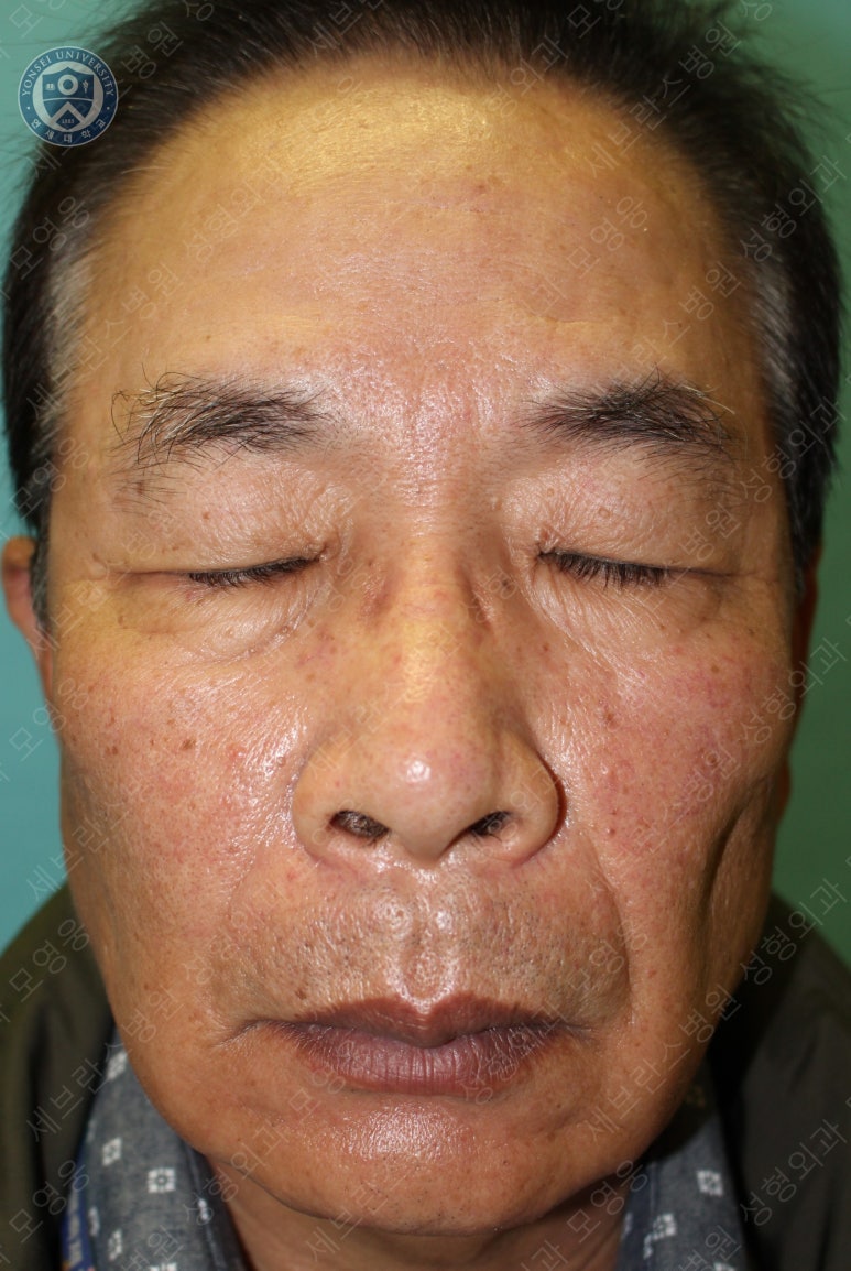 67세 남성, 상&middot;하안검성형술 및 안검하수교정 (67/M, Upper &  lower blepharoplasty with ptosis correction) 관련 이미지 3