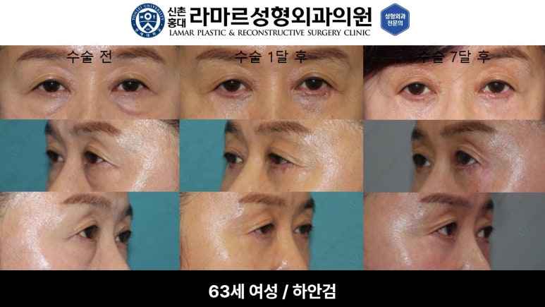 30대~80대 눈 수술 케이스 : 하안검성형술 전후 사진 모음 관련 이미지 6