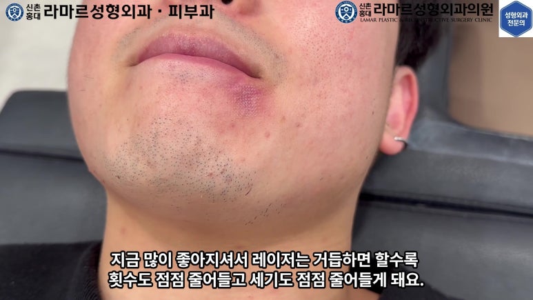 개에 물려 입술 1/3이 뜯긴 19세 남자분 치료 및 흉터 성형수술& 레이저 후기....! 관련 이미지 83