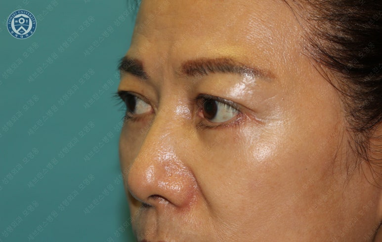 59세 여성, 그레이브스 안병증이 있는 돌출눈 중년 여성 하안검 성형술 (Lower blepharoplasty in Graves 관련 이미지 30