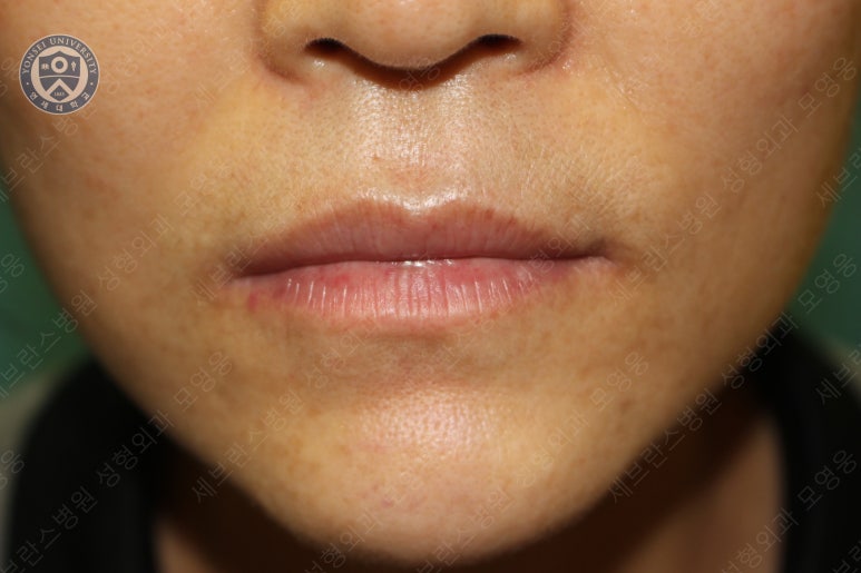 55세 여성, 이중평면 안면거상(55/F, Dual-plane full facelift) 관련 이미지 48