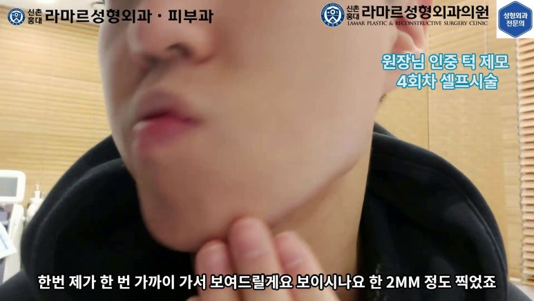 [성형외과 전문의의 셀프시술 제8편] 인중, 아래턱 제모 4회차 결과 공개! 관련 이미지 93