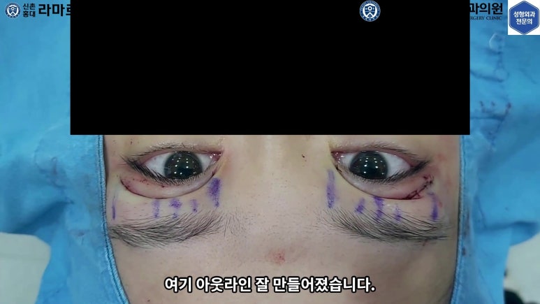 매몰 쌍꺼풀 풀고 절개쌍꺼풀로 바꾸는 쌍꺼풀 재수술!! 관련 이미지 37