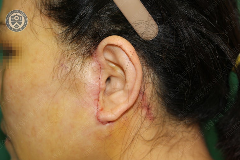 55세 여성, 이중평면 안면거상(55/F, Dual-plane full facelift) 관련 이미지 31