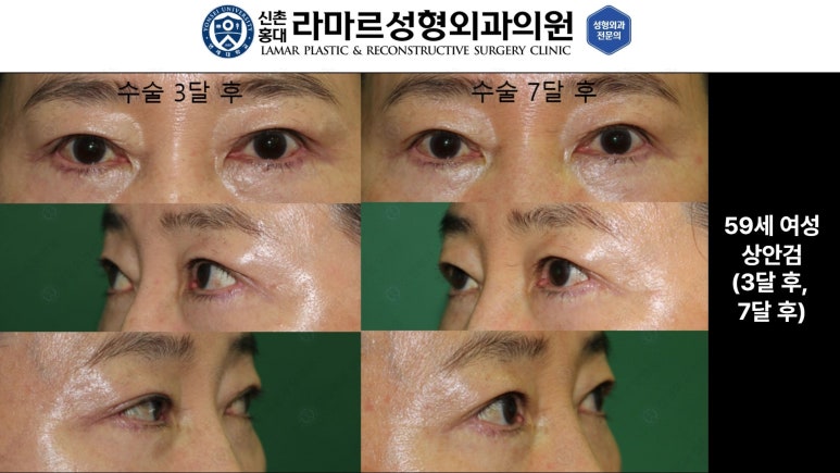 40대~80대 눈 수술 케이스 : 상안검성형술 전후 사진 모음 관련 이미지 24
